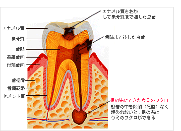 歯周療法イラスト