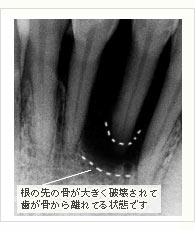 歯周病（歯槽膿漏）末期症状