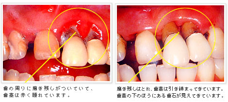 歯周病治療例