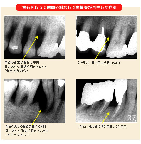 歯石を取って歯周外科なしで歯槽骨が再生した症例